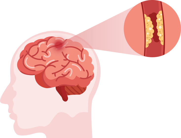 Stroke disease. Hemorrhagic brain stroke concept. Apoplexy,